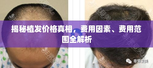揭秘植發(fā)價(jià)格真相，費用因素、費用范圍全解析