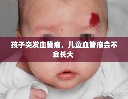 孩子突發(fā)血管瘤，兒童血管瘤會(huì )不會(huì )長(cháng)大 